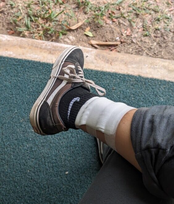 Inès avec un bandage autour du pied après une brûlure en Thaïlande. Une des pires galères de voyage, mais on garde le moral